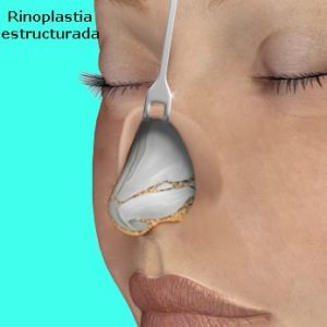 rinoplastia-estructurada