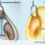 Tipos de rinoplastia, abierta y cerrada