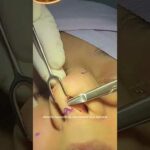 Rinoplastia en España: Mejora tu nariz con los mejores cirujanos
