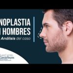 Dr. Juan Peñas: Precio de Rinoplastia al alcance de todos