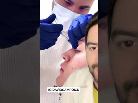 Rinoplastia con el Dr. Peñas: la mejor opción para una nariz perfecta